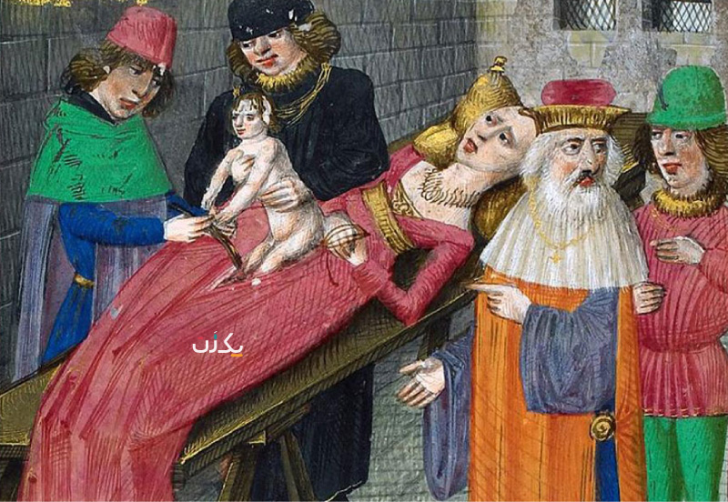 تاریخچه سزارین